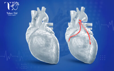 جراحة ترقيع الشرايين التاجية