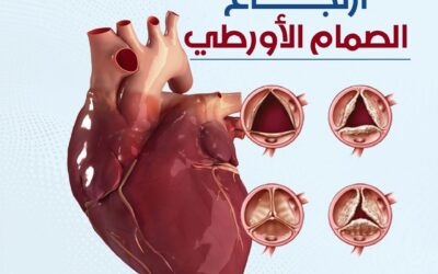 ارتجاع الصمام الأورطي