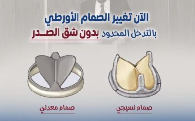 الآن تغيير الصمام الأورطي بالتدخل المحدود دون شق الصدر