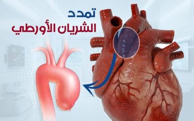 تمدد الشريان الأورطي