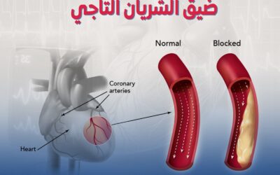 ضيق الشريان التاجي