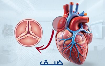 ضيق الصمام الأورطي